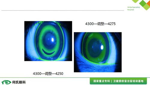 角膜塑形镜常规问题处理与反射膜维护指南